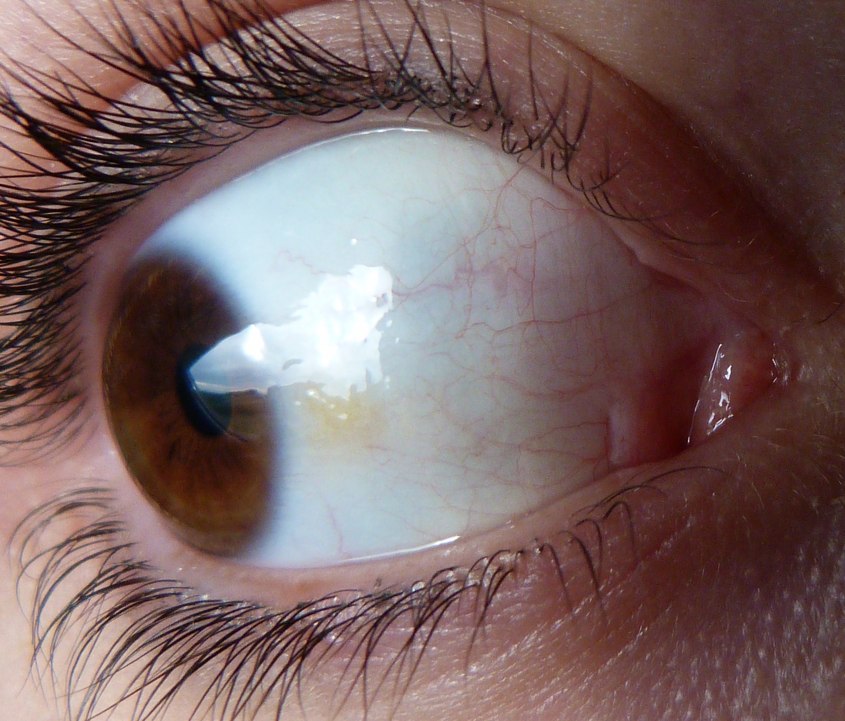 Taches Dans Les Yeux Myopie Cataracte Et Problemes De Vue Forum Sante Doctissimo Taches Dans Les Yeux Myopie Cataracte Et Problemes De Vue Forum Sante Doctissimo