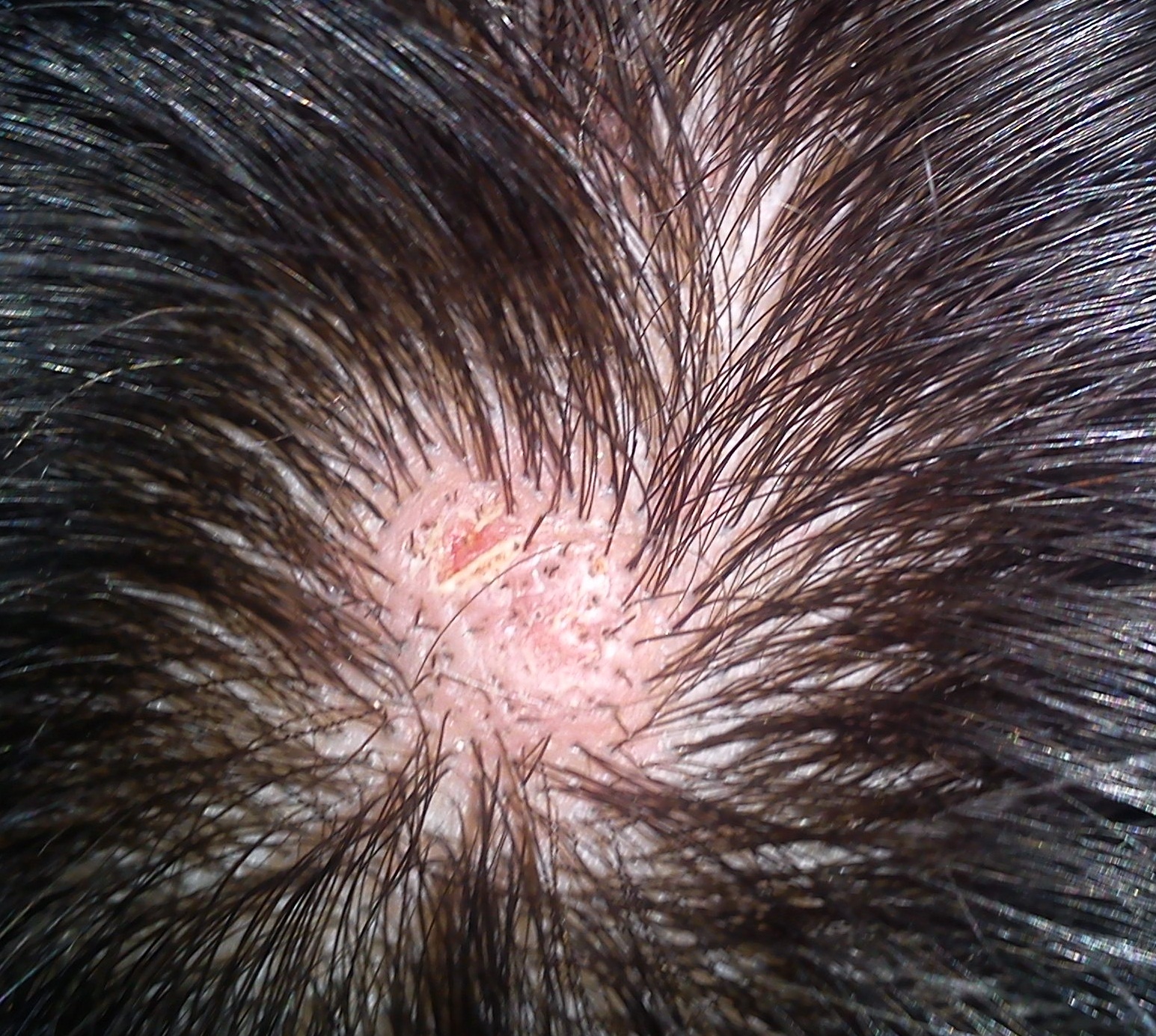Plaies Sur Le Cuir Chevelu Photos Acne Psoriasis Et Problemes De Peau Forum Sante Doctissimo Plaies Sur Le Cuir Chevelu Photos Acne Psoriasis Et Problemes De Peau Forum Sante Doctissimo