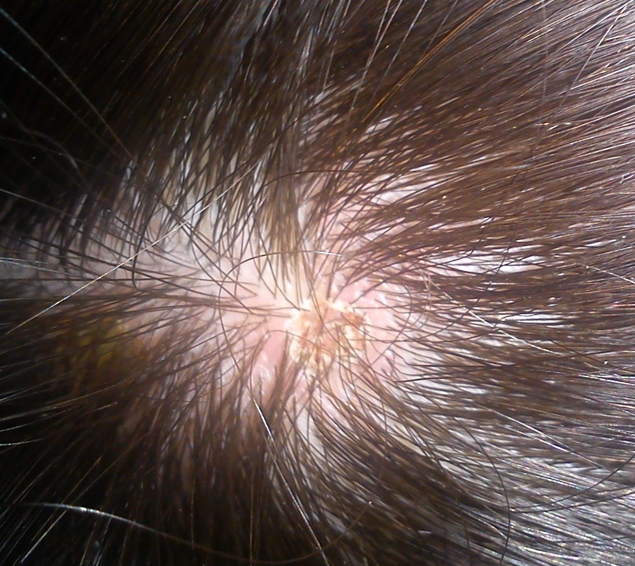 Plaies Sur Le Cuir Chevelu Photos Acne Psoriasis Et Problemes De Peau Forum Sante Doctissimo Plaies Sur Le Cuir Chevelu Photos Acne Psoriasis Et Problemes De Peau Forum Sante Doctissimo