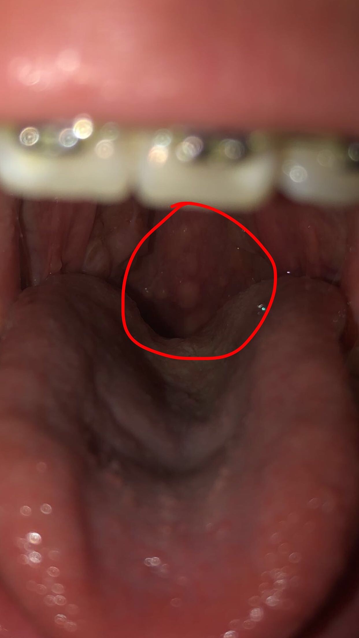 Sorte De Boutons Dans Le Fond De La Gorge Maladies Auto Immunes Forum Sante Doctissimo