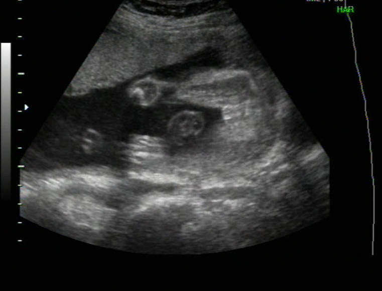 Echo 22sa Fille Ou Garcon Echographie Connaitre Le Sexe De Votre Bebe Forum Grossesse Amp Bebe Doctissimo Echo 22sa Fille Ou Garcon Echographie Connaitre Le Sexe De Votre Bebe Forum Grossesse Amp Bebe Doctissimo