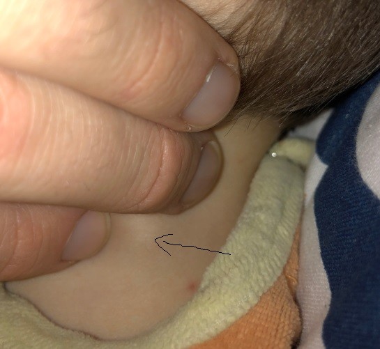 Petit Ganglion Cou Enfant 2 Ans Sante De L Enfant Forum Sante Doctissimo