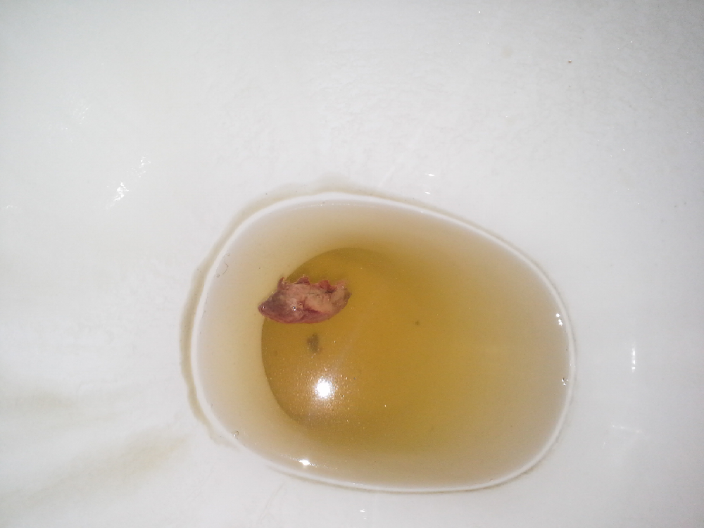 Perte Bizarre Fausse Couche Forum Grossesse Amp Bebe Doctissimo Perte Bizarre Fausse Couche Forum Grossesse Amp Bebe Doctissimo