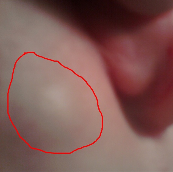 Ganglions Ou Kyste Photos Ganglions Ou Kyste Photos