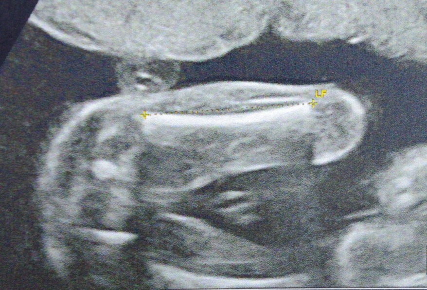 Echo De 18sa Vos Verdicts Sur Le Sexe Svp Echographie Connaitre Le Sexe De Votre Bebe Forum Grossesse Amp Bebe Doctissimo Echo De 18sa Vos Verdicts Sur Le Sexe Svp Echographie Connaitre Le Sexe De Votre Bebe Forum Grossesse Amp Bebe Doctissimo