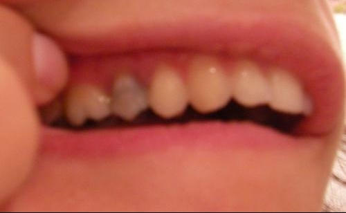 Que Feriez Vous A Ma Place Couronne Problemes Dentaires Forum Sante Doctissimo