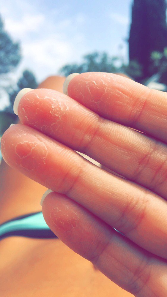 Peau Qui Pele Doigt Et Pied Allergies Et Eczema Forum Sante Doctissimo Peau Qui Pele Doigt Et Pied Allergies Et Eczema Forum Sante Doctissimo