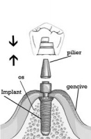schema implant