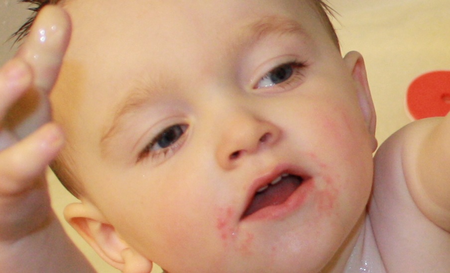Impetigo Mamans Et Futures Mamans Du Quebec Forum Grossesse Amp Bebe Doctissimo Impetigo Mamans Et Futures Mamans Du Quebec Forum Grossesse Amp Bebe Doctissimo