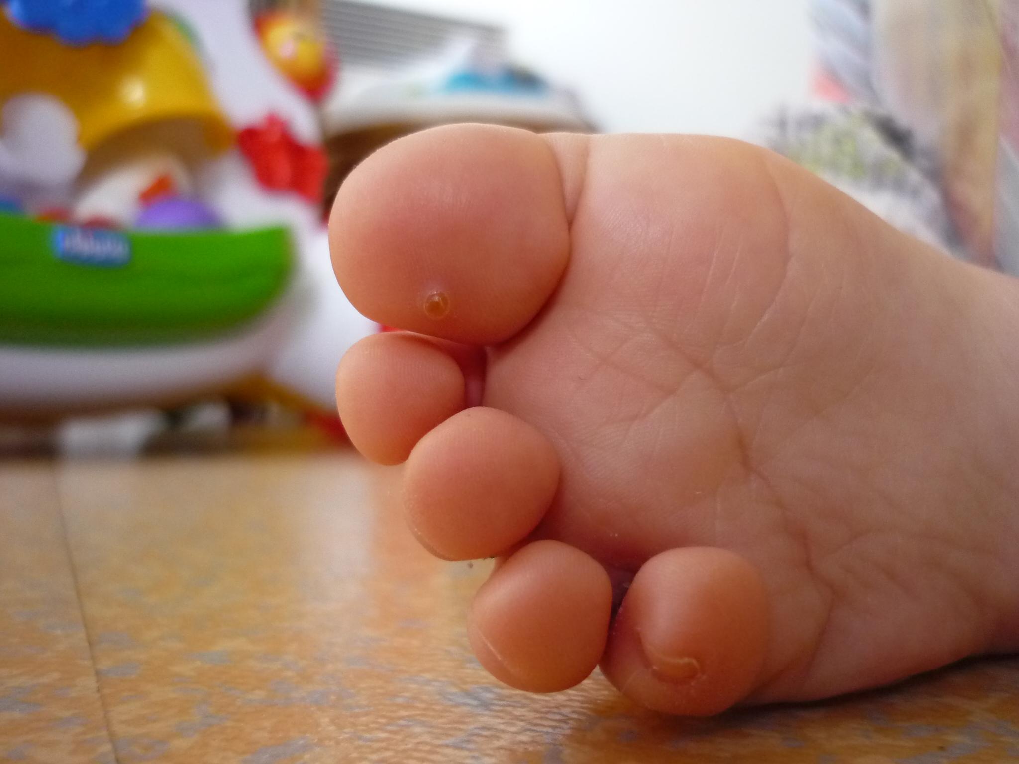 Je Crois Qu Il A Une Verrue Plantaire Ca Y Est Verrue Brulee Bebe Grandit Forum Grossesse Amp Bebe Doctissimo Je Crois Qu Il A Une Verrue Plantaire Ca Y Est Verrue Brulee Bebe Grandit Forum Grossesse Amp Bebe Doctissimo
