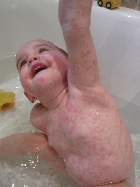Allergie Aux Antibio Impressionnant Bebe Grandit Forum Grossesse Amp Bebe Doctissimo