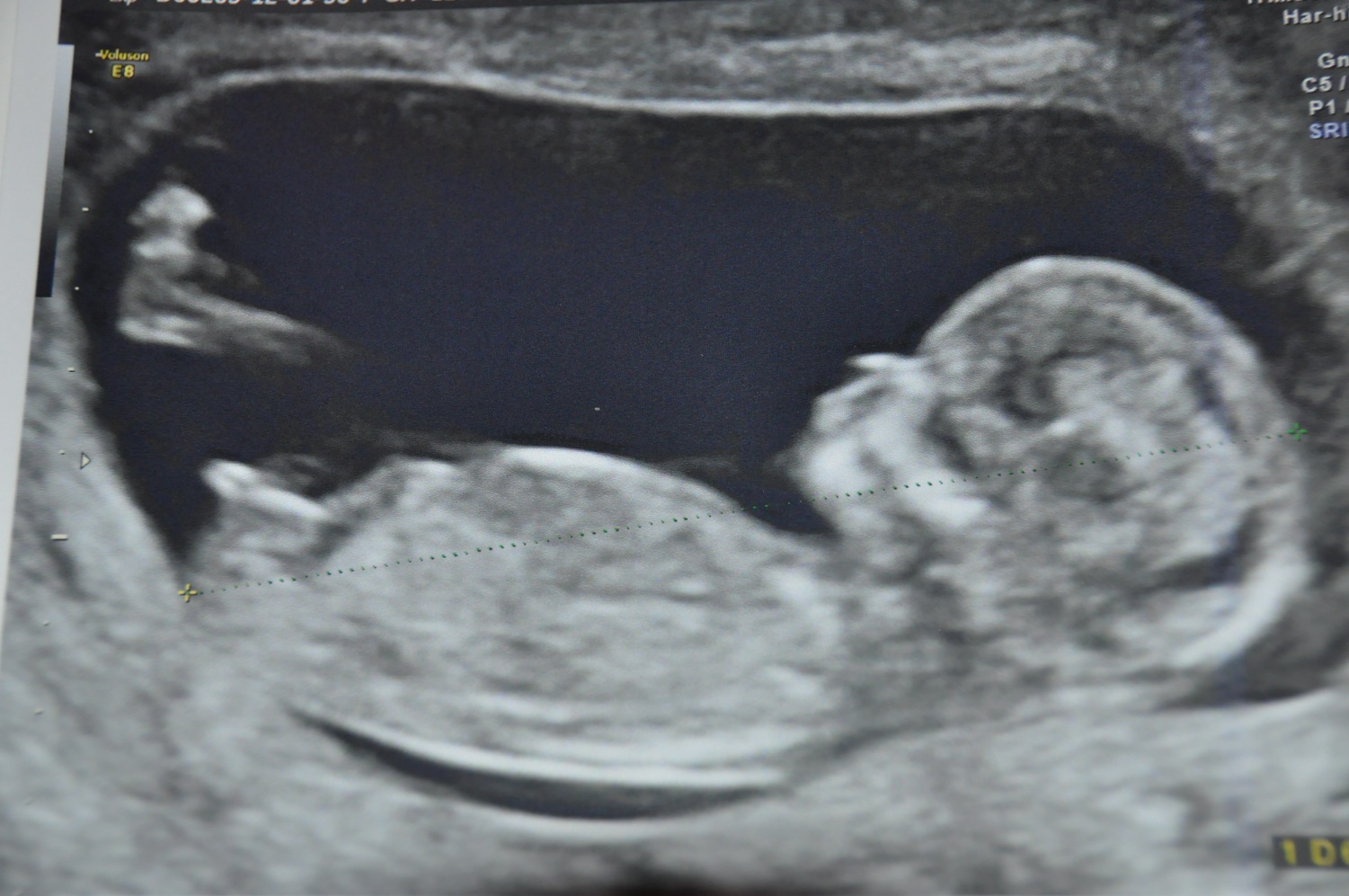 Echo 12 Sa 2 Jours Fille Ou Garcon Echographie Connaitre Le Sexe De Votre Bebe Forum Grossesse Amp Bebe Doctissimo