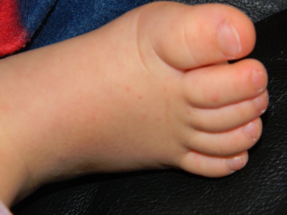 Syndrome Pied Main Bouche Syndrome Pied Main Bouche