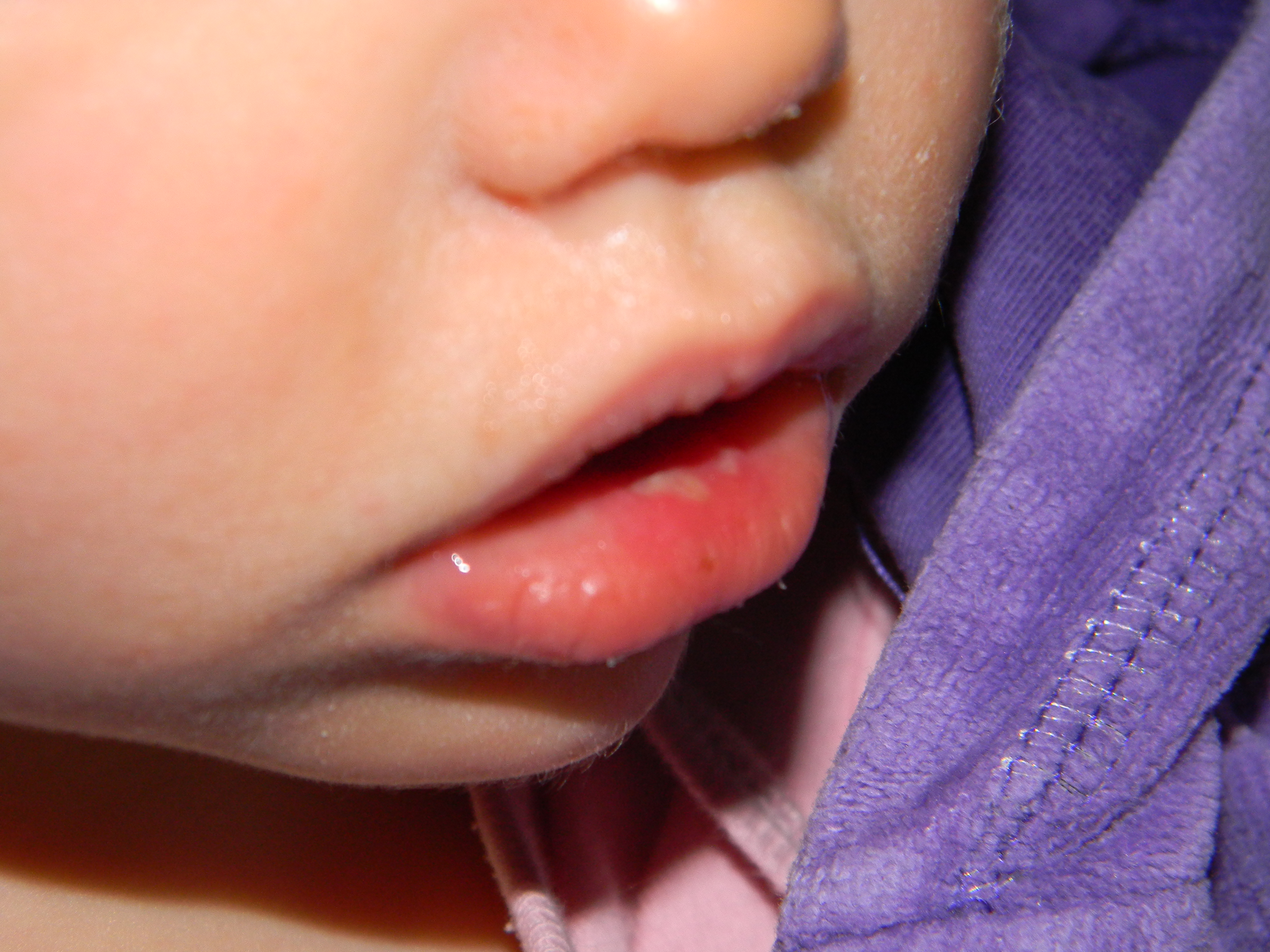 Syndrome Pied Main Bouche Bebe Grandit Forum Grossesse Amp Bebe Doctissimo Syndrome Pied Main Bouche Bebe Grandit Forum Grossesse Amp Bebe Doctissimo