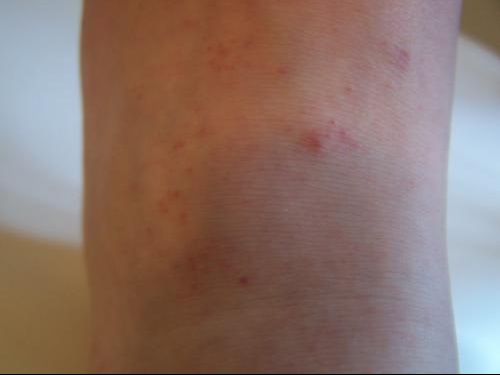 Petit Point Rouge Sang En Veux Tu En Voilaa Acne Psoriasis Et Problemes De Peau Forum Sante