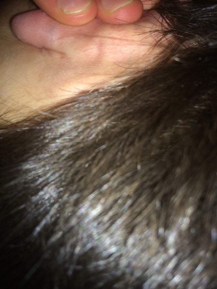 Bosse Derriere L Oreille Forum Libre Sante Forum Sante Doctissimo Bosse Derriere L Oreille Forum Libre Sante Forum Sante Doctissimo