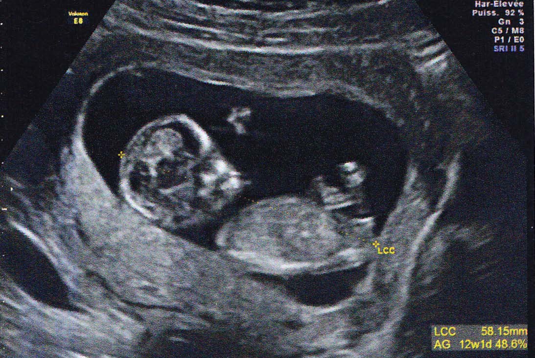 Echo A 12 Sa Garcon Ou Fille Echographie Connaitre Le Sexe De Votre Bebe Forum Grossesse Amp Bebe Doctissimo Echo A 12 Sa Garcon Ou Fille Echographie Connaitre Le Sexe De Votre Bebe Forum Grossesse Amp Bebe Doctissimo