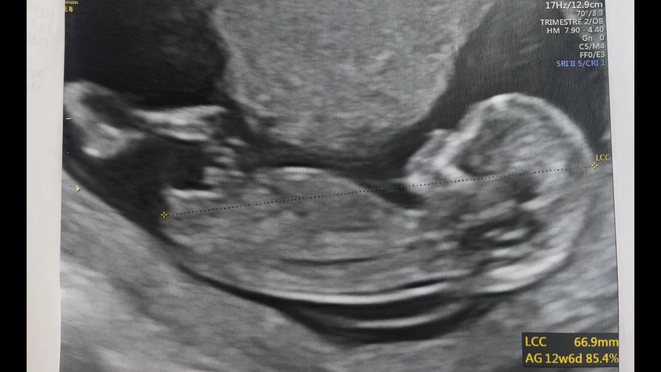 Echo 12sa 6 Avis Bourgeon Bebe Verdict Final 22sa Echographie Connaitre Le Sexe De Votre Bebe Forum Grossesse Amp Bebe Doctissimo