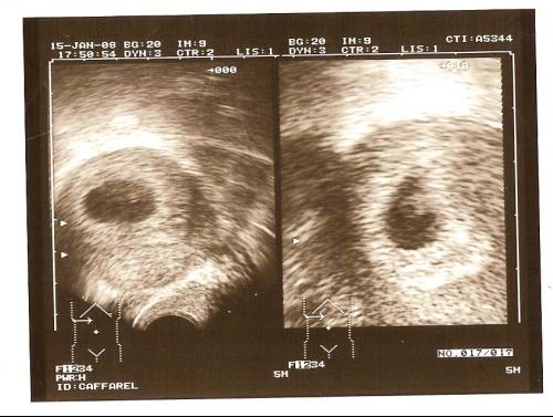 Pourquoi Faire Forcement Des Echo A Seulement 6 Semaines Echographie Connaitre Le Sexe De Votre Bebe Forum Grossesse Amp Bebe Doctissimo