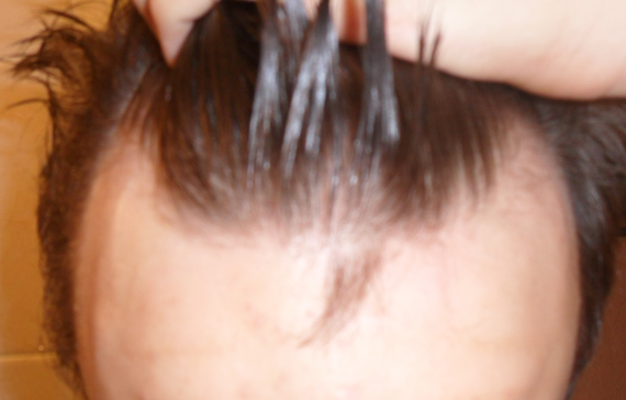 début calvitie