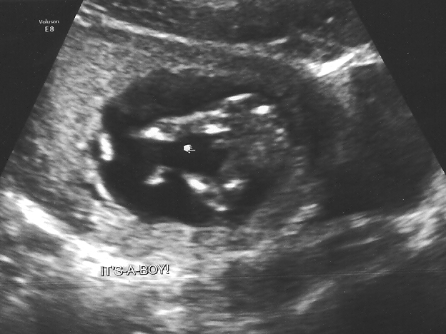 Echo 13 Semaines Et Ben Oui C Est Parfois Plus Que Visible Lol Echographie Connaitre Le Sexe De Votre Bebe Forum Grossesse Amp Bebe Doctissimo Echo 13 Semaines Et Ben Oui C Est Parfois Plus Que Visible Lol Echographie Connaitre Le Sexe De Votre Bebe Forum Grossesse Amp Bebe Doctissimo