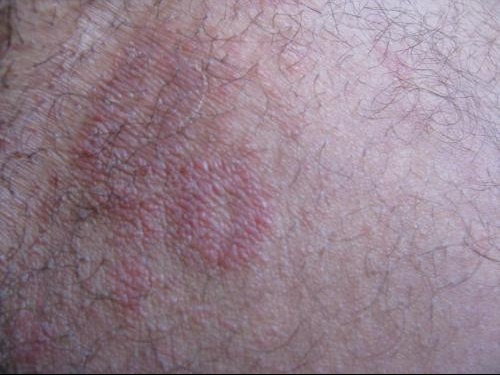 (PHOTO) plaques rouges, qu'est ce que c'est?