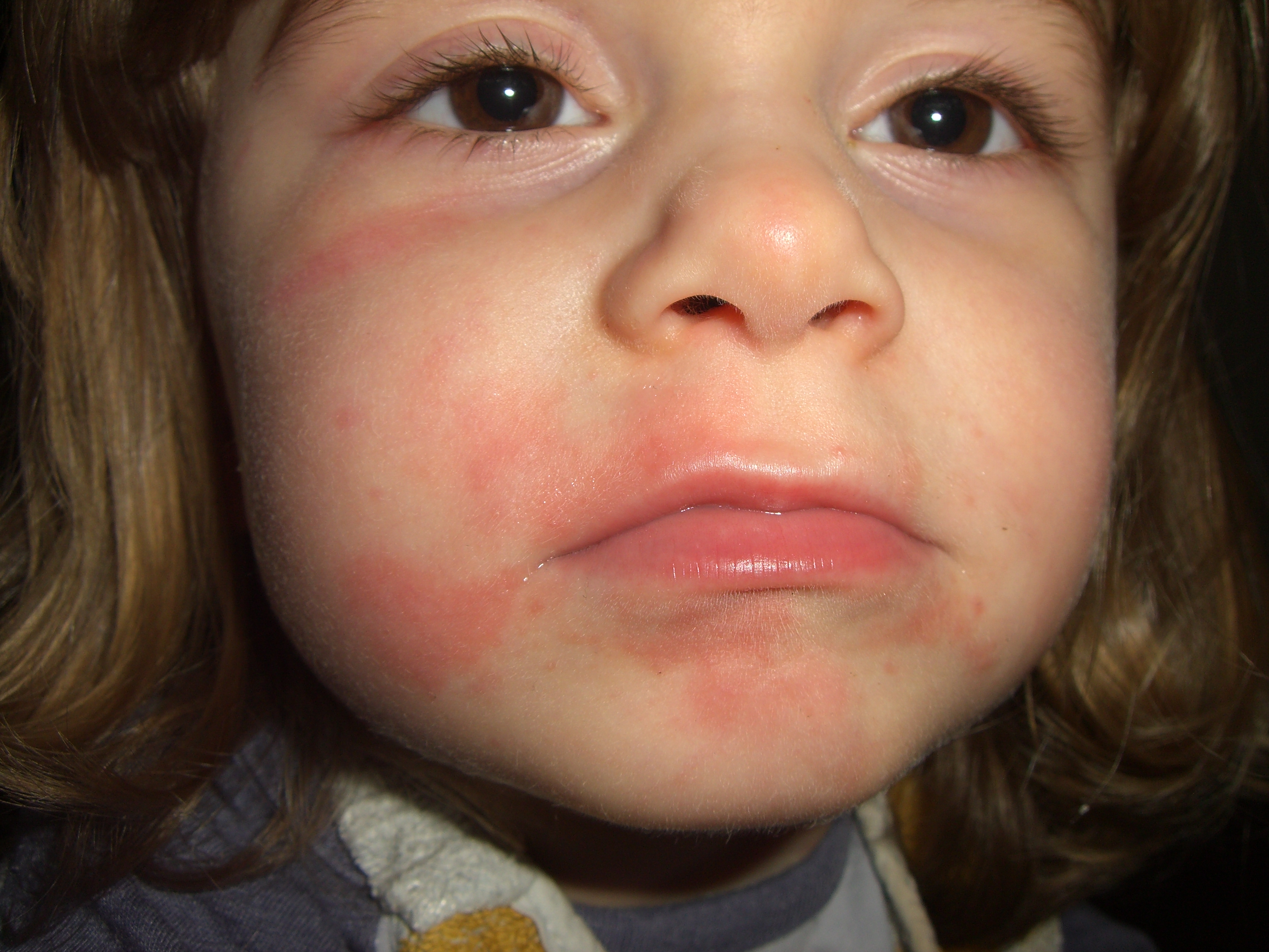 Allergie Tomate Symptomes