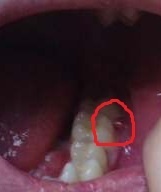 Nouveau Gonflement Et Boule De Chair Apres Extraction Dent De Sagesse Problemes Dentaires Forum Sante Doctissimo Nouveau Gonflement Et Boule De Chair Apres Extraction Dent De Sagesse Problemes Dentaires Forum Sante Doctissimo