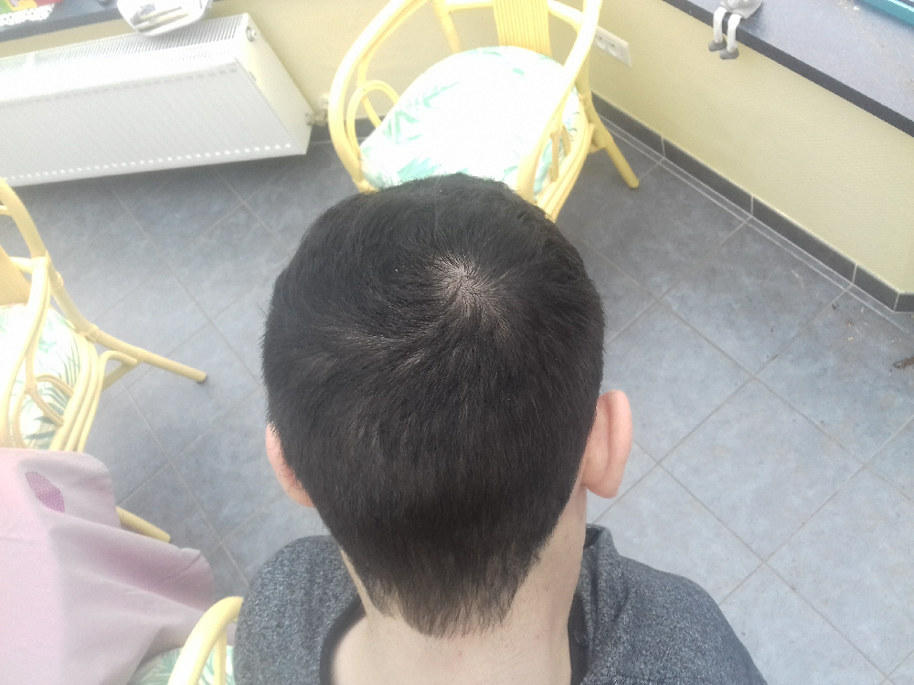 Debut De Calvitie A 16 Ans Calvitie a 16ans? - Calvitie et perte de cheveux - FORUM Santé