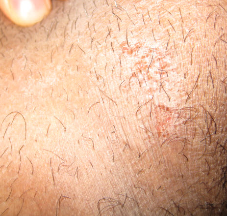 Des Plaies Qui Saignet Sur Les Testicules Infections Sexuellement Transmissibles Forum Sante Doctissimo Des Plaies Qui Saignet Sur Les Testicules Infections Sexuellement Transmissibles Forum Sante Doctissimo