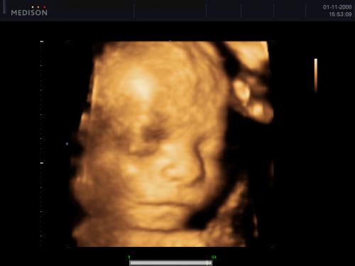 Echo 3d De Mon Petit Homme A 28sa 4 Jours Futures Mamans Forum Grossesse Amp Bebe Doctissimo