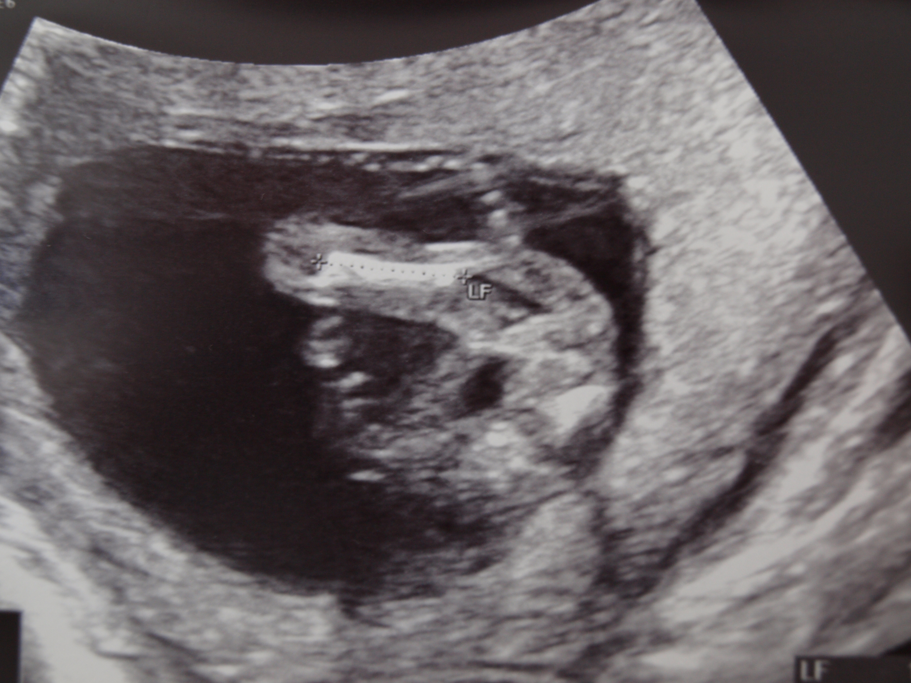 Echos Entre Jambe De Bebe A 12 Sa Donnez Moi Votre Avis Ls Filles Svp Echographie Connaitre Le Sexe De Votre Bebe Forum Grossesse Amp Bebe Doctissimo Echos Entre Jambe De Bebe A 12 Sa Donnez Moi Votre Avis Ls Filles Svp Echographie Connaitre Le Sexe De Votre Bebe Forum Grossesse Amp Bebe Doctissimo