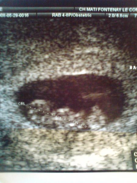 Mon Echo A 7sa 6 5sg 6 Evolution Echographie Connaitre Le Sexe De Votre Bebe Forum Grossesse Amp Bebe Doctissimo
