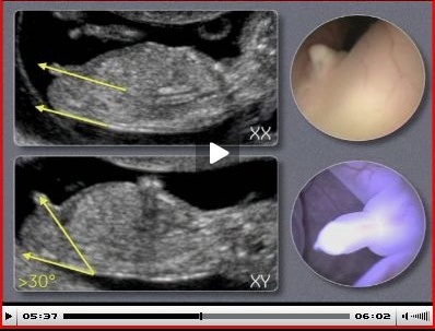 Echo A 12sa 1j J Ai Le Verdict Echographie Connaitre Le Sexe De Votre Bebe Forum Grossesse Amp Bebe Doctissimo