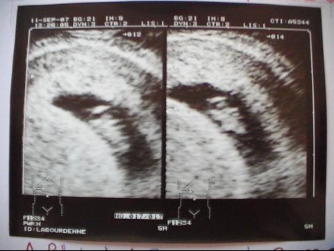 Taille Embryon A 7 5 Sa Echographie Connaitre Le Sexe De Votre Bebe Forum Grossesse Amp Bebe Doctissimo