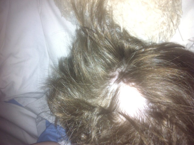 Pelade Enfant 5ans Depuis 2 Ans Calvitie Et Perte De Cheveux Forum Sante Doctissimo Pelade Enfant 5ans Depuis 2 Ans Calvitie Et Perte De Cheveux Forum Sante Doctissimo