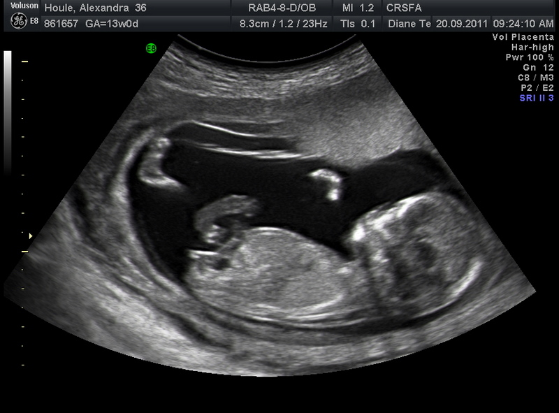 Echo A sa Vos Avis Svp Echographie Connaitre Le Sexe De Votre Bebe Forum Grossesse Amp Bebe Doctissimo