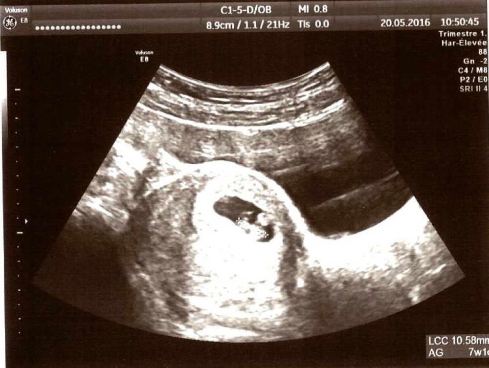 Taille Embryon 7sa 5 Echographie Connaitre Le Sexe De Votre Bebe Forum Grossesse Amp Bebe Doctissimo Taille Embryon 7sa 5 Echographie Connaitre Le Sexe De Votre Bebe Forum Grossesse Amp Bebe Doctissimo