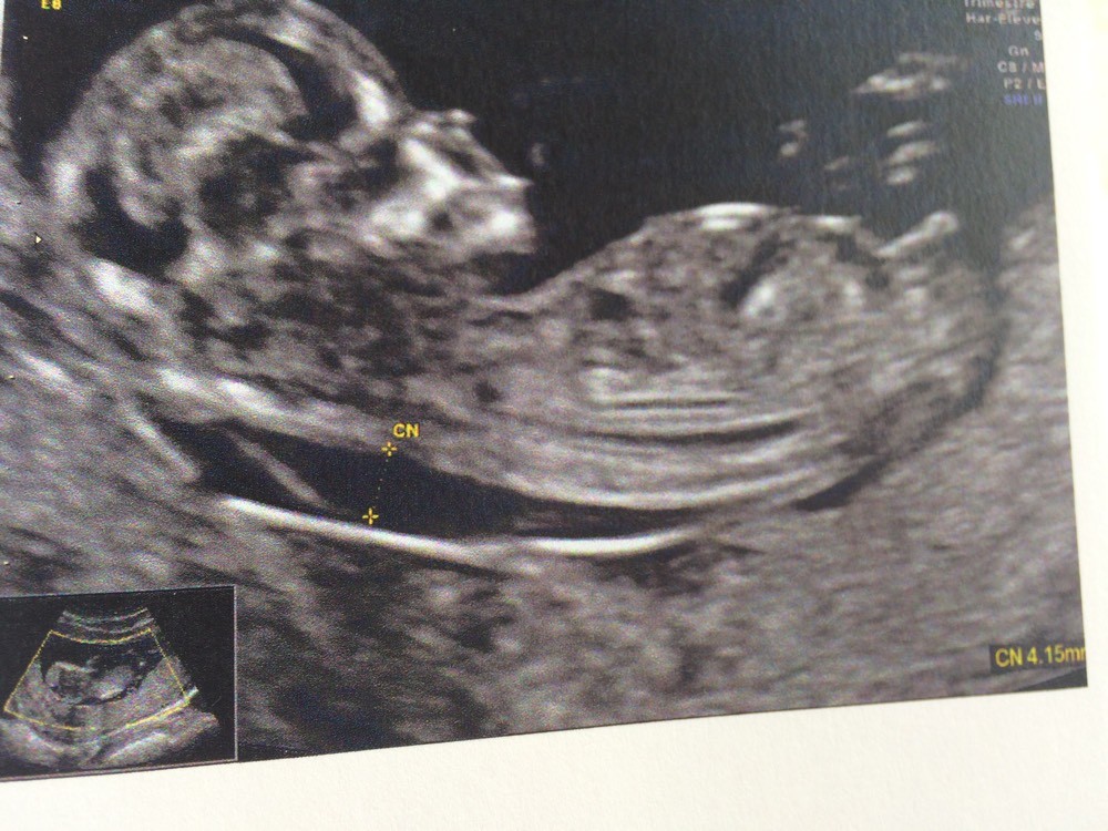 Cn Epaisse Biopsie Amniocentese Forum Grossesse Amp Bebe Doctissimo Cn Epaisse Biopsie Amniocentese Forum Grossesse Amp Bebe Doctissimo