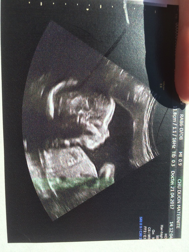 Cn Epaisse Biopsie Amniocentese Forum Grossesse Amp Bebe Doctissimo Cn Epaisse Biopsie Amniocentese Forum Grossesse Amp Bebe Doctissimo