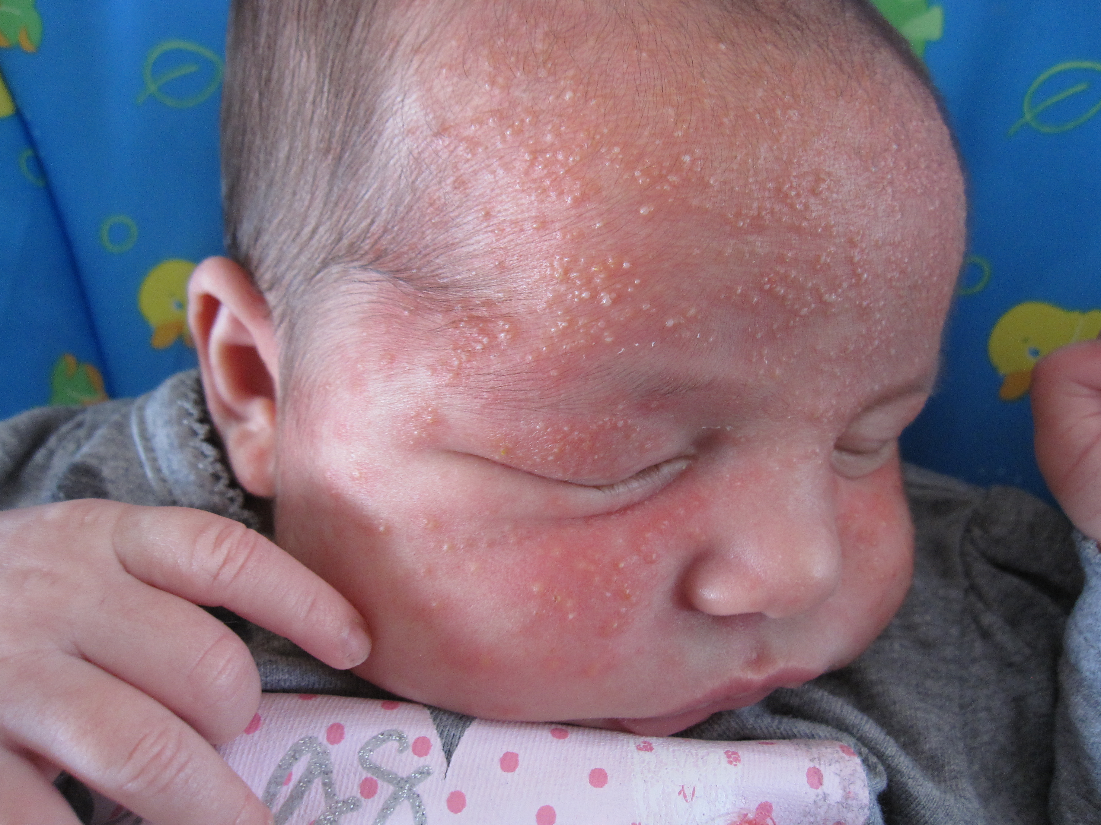 Acnee Du Nourisson Edit Photo Mamans Et Futures Mamans Du Quebec Forum Grossesse Amp Bebe Doctissimo Acnee Du Nourisson Edit Photo Mamans Et Futures Mamans Du Quebec Forum Grossesse Amp Bebe Doctissimo