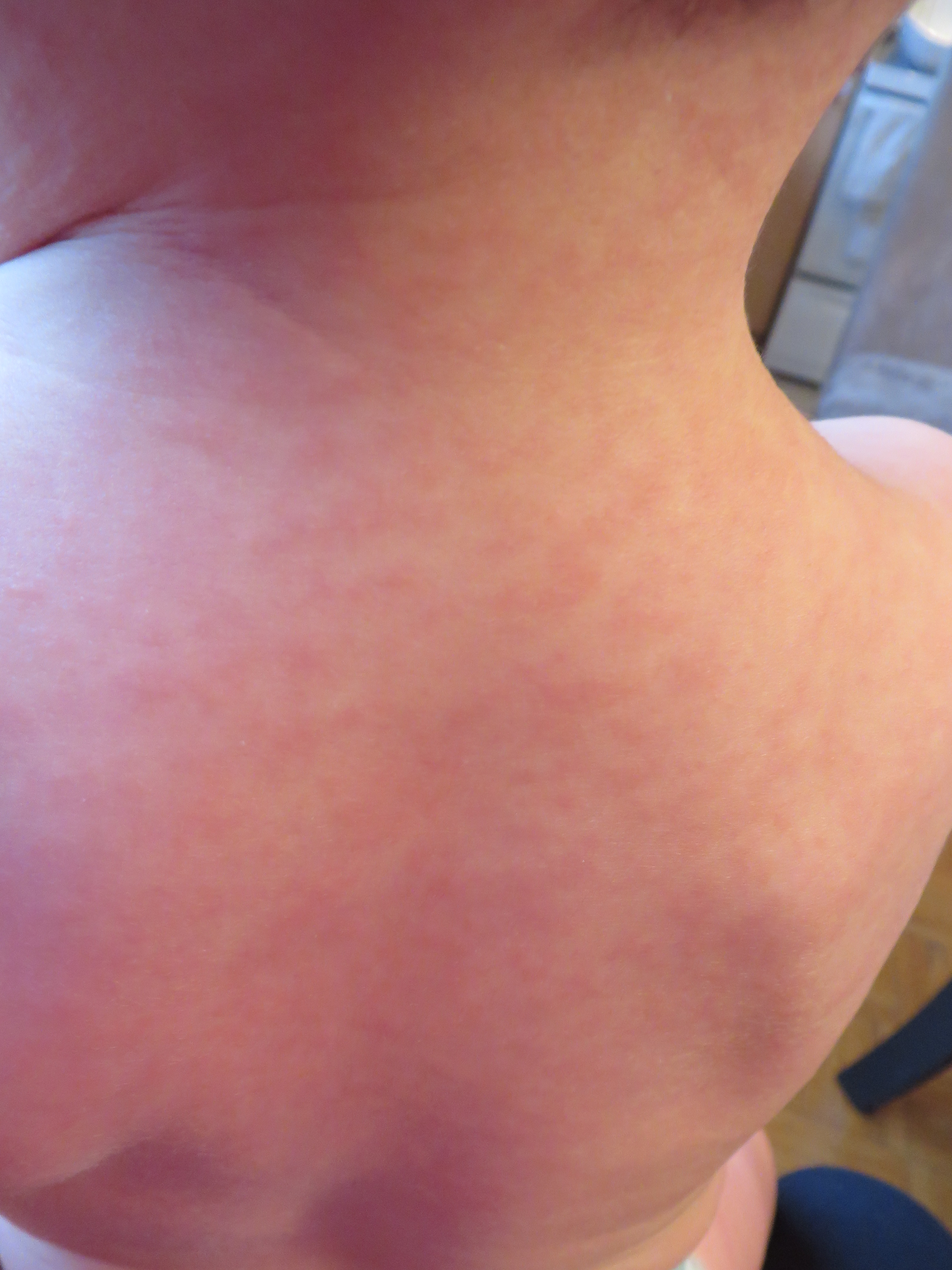 Photos Scarlatine Ou Roseole Mamans Et Futures Mamans Du Quebec Forum Grossesse Amp Bebe Doctissimo Photos Scarlatine Ou Roseole Mamans Et Futures Mamans Du Quebec Forum Grossesse Amp Bebe Doctissimo