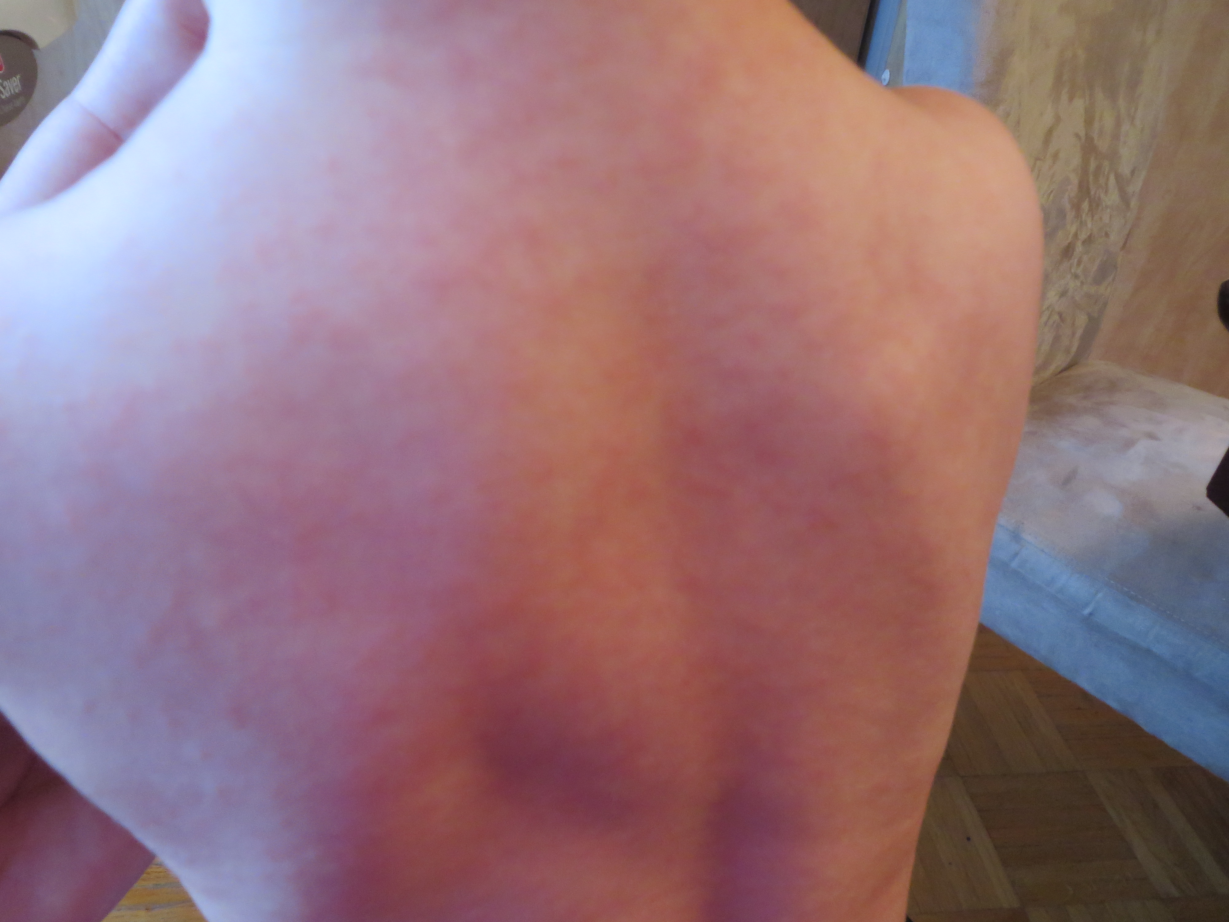 Photos Scarlatine Ou Roseole Mamans Et Futures Mamans Du Quebec Forum Grossesse Amp Bebe Doctissimo Photos Scarlatine Ou Roseole Mamans Et Futures Mamans Du Quebec Forum Grossesse Amp Bebe Doctissimo