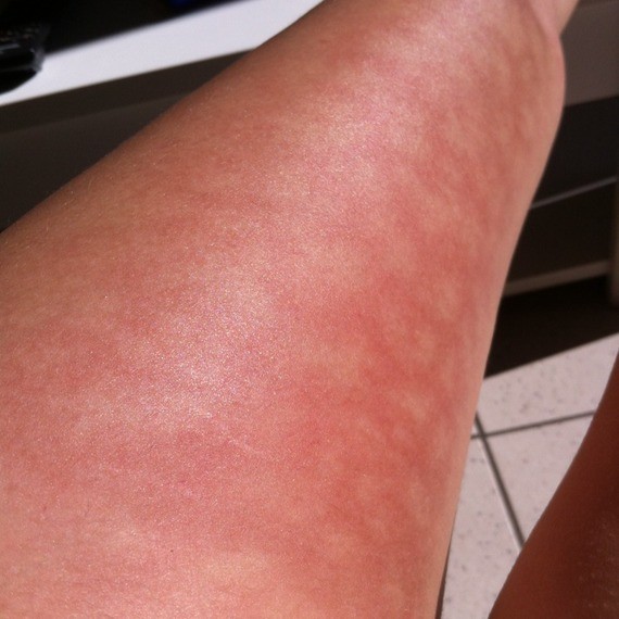 Plaques Rouges Jambes at Thomas Castro blog