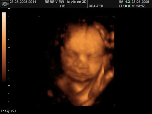 Post Pour Montrer Votre Echo 3d Echographie Connaitre Le Sexe De Votre Bebe Forum Grossesse Amp Bebe Doctissimo Post Pour Montrer Votre Echo 3d Echographie Connaitre Le Sexe De Votre Bebe Forum Grossesse Amp Bebe Doctissimo