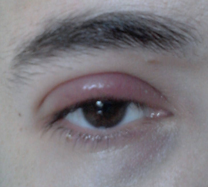 Paupieres Gonflees Rouges Et Demangeaisons Allergies Et Eczema Forum Sante Doctissimo Paupieres Gonflees Rouges Et Demangeaisons Allergies Et Eczema Forum Sante Doctissimo