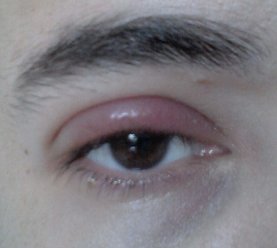 Paupières Rouges Paupières gonflées,rouges et démangeaisons - Allergies et eczéma ...
