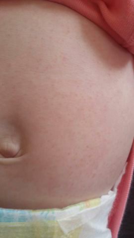 Acne De Bebe Ou Allergie Bebe Grandit Forum Grossesse Amp Bebe Doctissimo Acne De Bebe Ou Allergie Bebe Grandit Forum Grossesse Amp Bebe Doctissimo