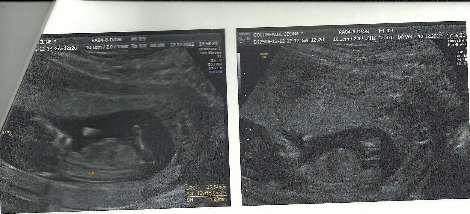 Echo 12sa 2 Vos Avis Nouvelle Echo 17sa 4 Echographie Connaitre Le Sexe De Votre Bebe Forum Grossesse Amp Bebe Doctissimo Echo 12sa 2 Vos Avis Nouvelle Echo 17sa 4 Echographie Connaitre Le Sexe De Votre Bebe Forum Grossesse Amp Bebe Doctissimo