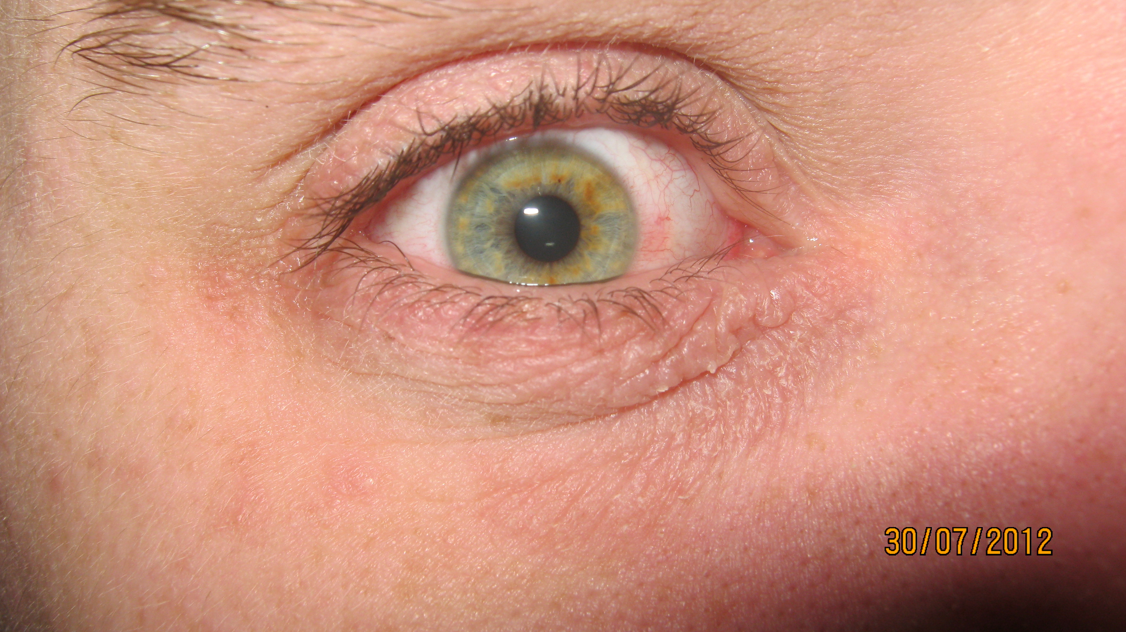 Yeux En Feu Help J Ai Trop Mal Allergies Et Eczema Forum Sante Doctissimo Yeux En Feu Help J Ai Trop Mal Allergies Et Eczema Forum Sante Doctissimo